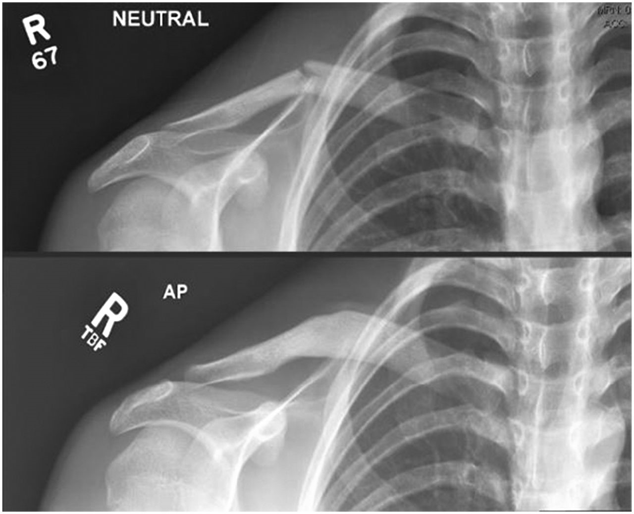 X Ray Broken Collar Bone